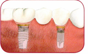 Pose d'implants dentaires Lyon