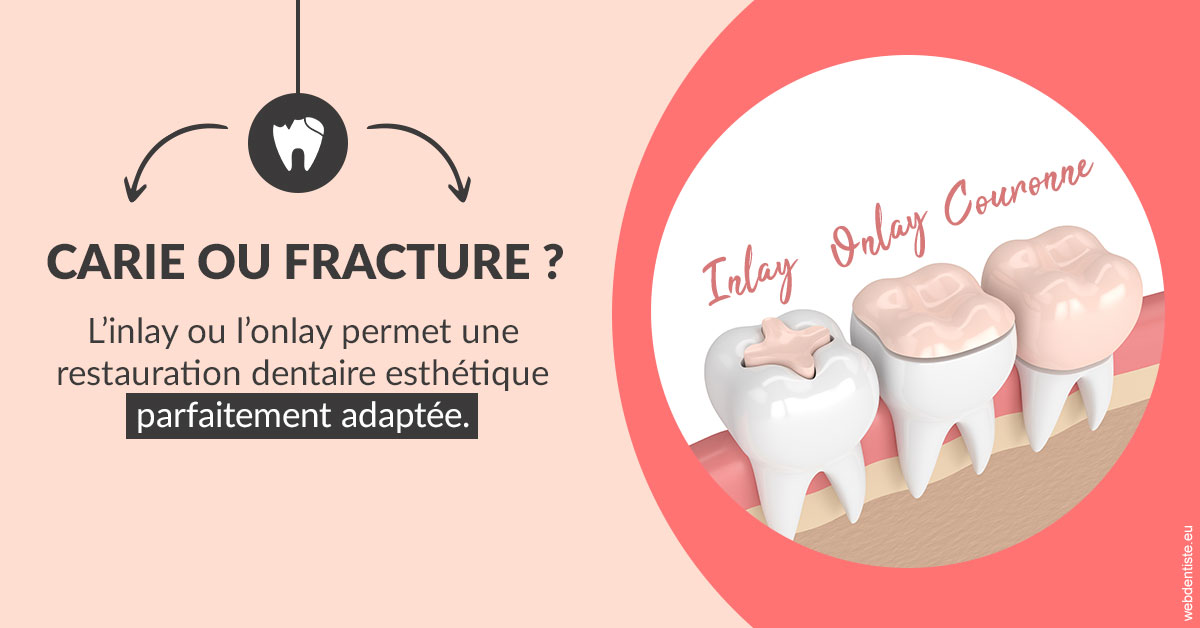 https://selarl-cabinet-sayac-et-associes.chirurgiens-dentistes.fr/T2 2023 - Carie ou fracture 2
