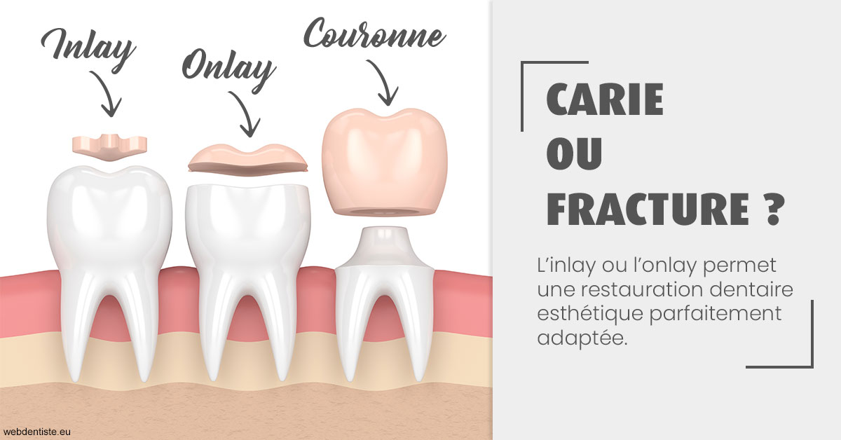 https://selarl-cabinet-sayac-et-associes.chirurgiens-dentistes.fr/T2 2023 - Carie ou fracture 1