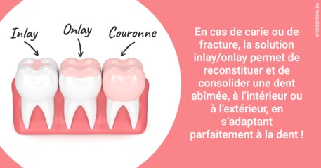https://selarl-cabinet-sayac-et-associes.chirurgiens-dentistes.fr/L'INLAY ou l'ONLAY 2